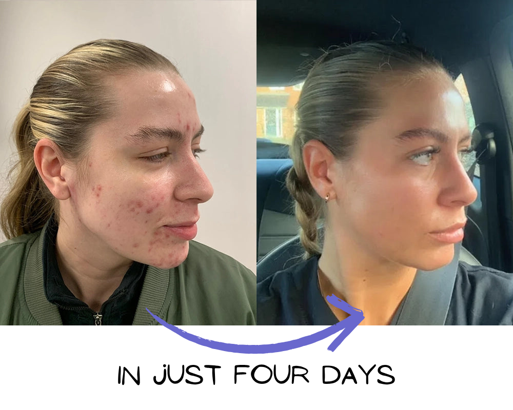 Before and after acne treatment results