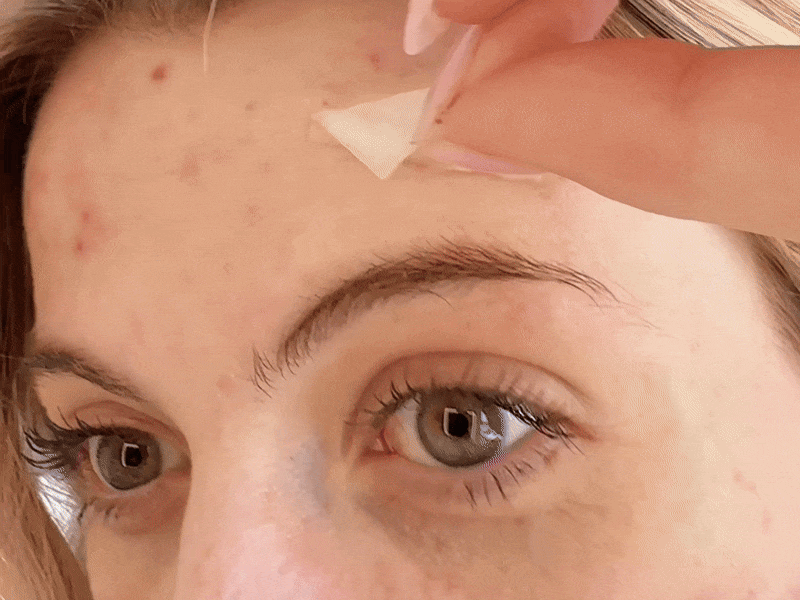 Hydrocolloid patch pulling impurities from skin